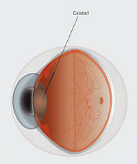 Cataract_Anatomy